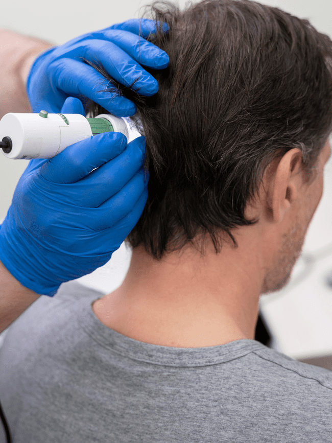 hombre recibiendo estudio capilar gratuito en nuestra clínica especialista en injerto capilar
