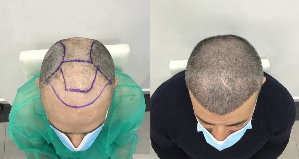 Hombre Antes y Después trasplante de pelo en nuestra clínica de injerto capilar