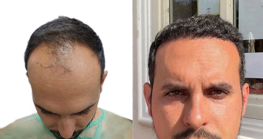 Hombre joven Antes y Después trasplante de pelo en nuestra clínica de injerto capilar
