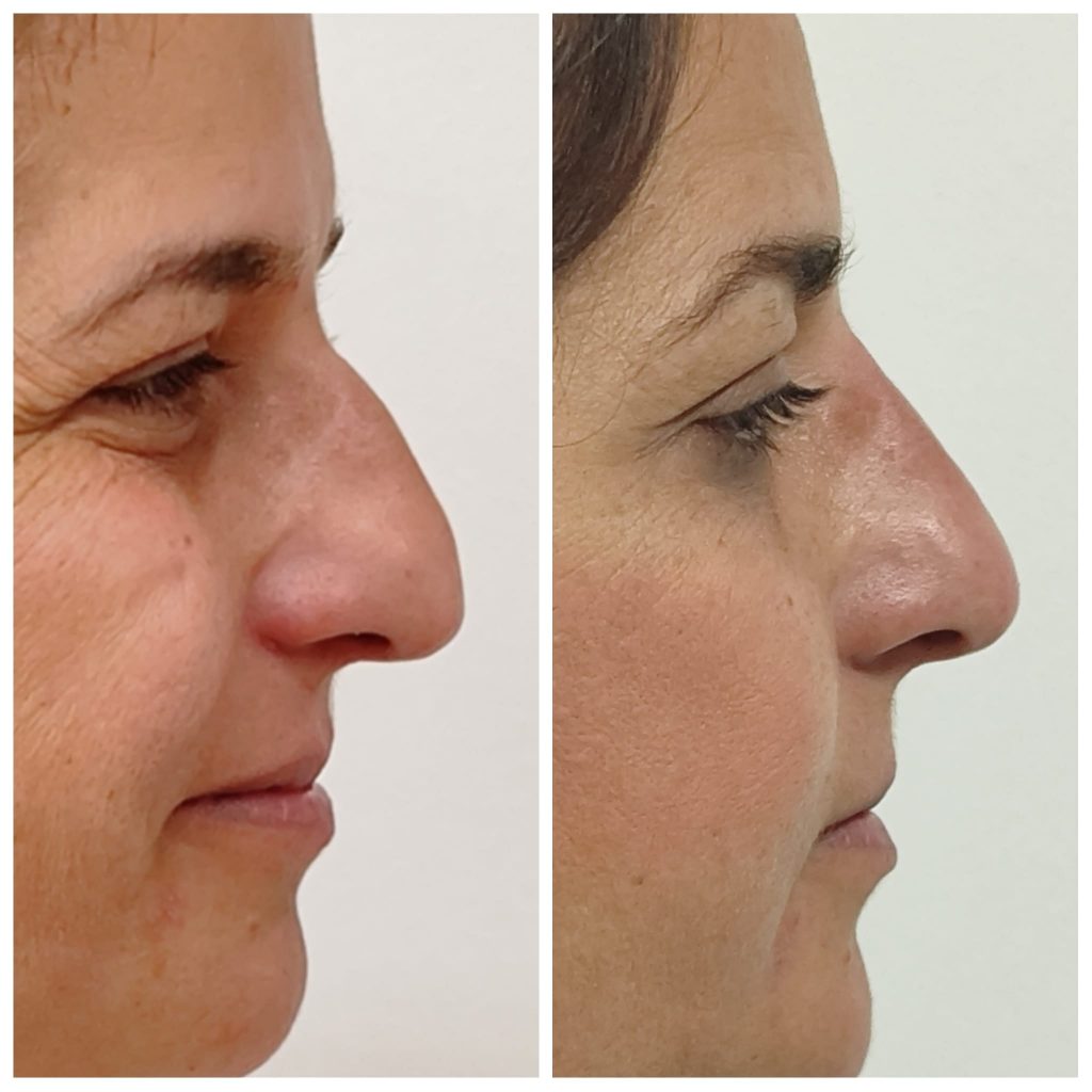 Antes y después de tratamiento de Rinomodelación en la nariz sin cirugía