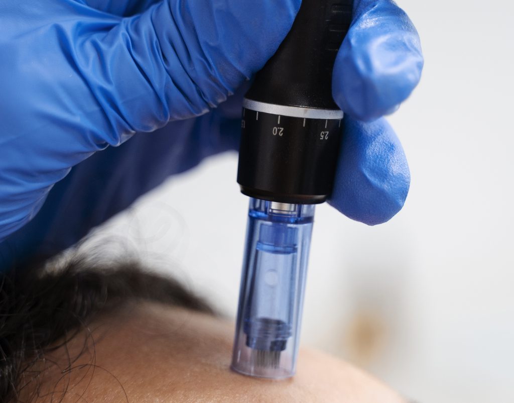 Dispositivos de micropunción aplicando tratamiento de microneedling con el que lograrás una piel hidratada, revitalizada y sin arrugas