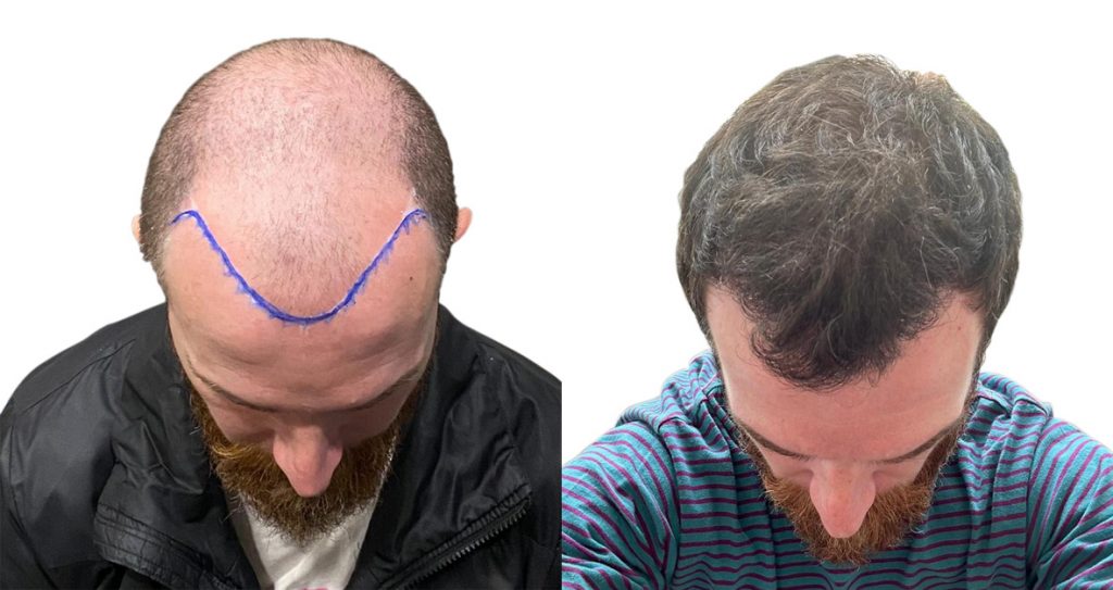 Hombre Antes y Después trasplante de pelo en nuestra clínica de injerto capilar con un resultado sorprendente