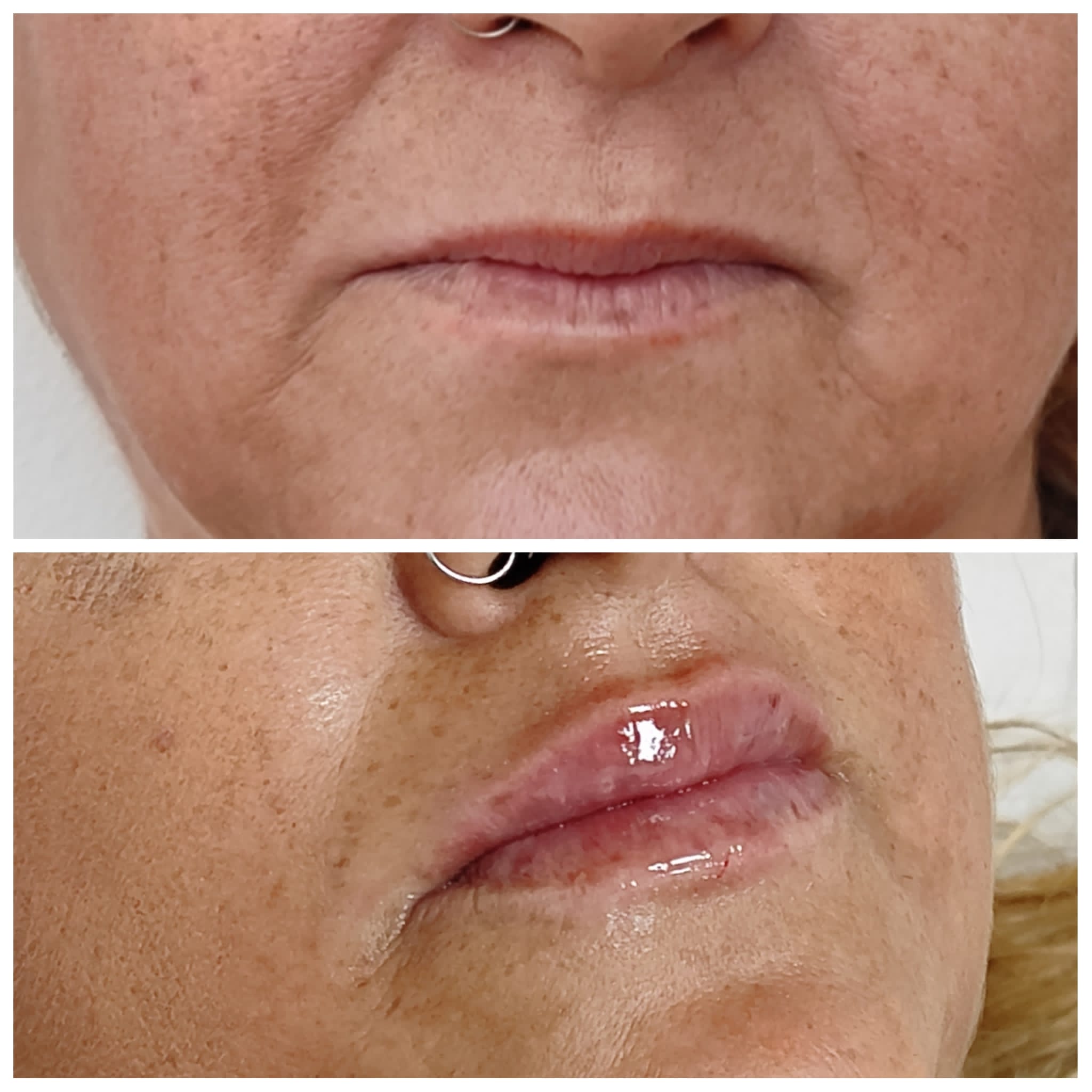 Antes y después del aumento de labios de una mujer tras realizarse un tratamiento de remodelación labial obteniendo un labio con aspecto natural, jovial, armónico y proporcionado