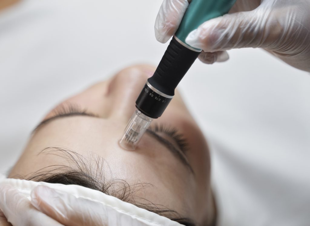 Aplicador de micropunción realizando tratamiento de Microneedling en la frente de mujer para mejorar la calidad de la piel