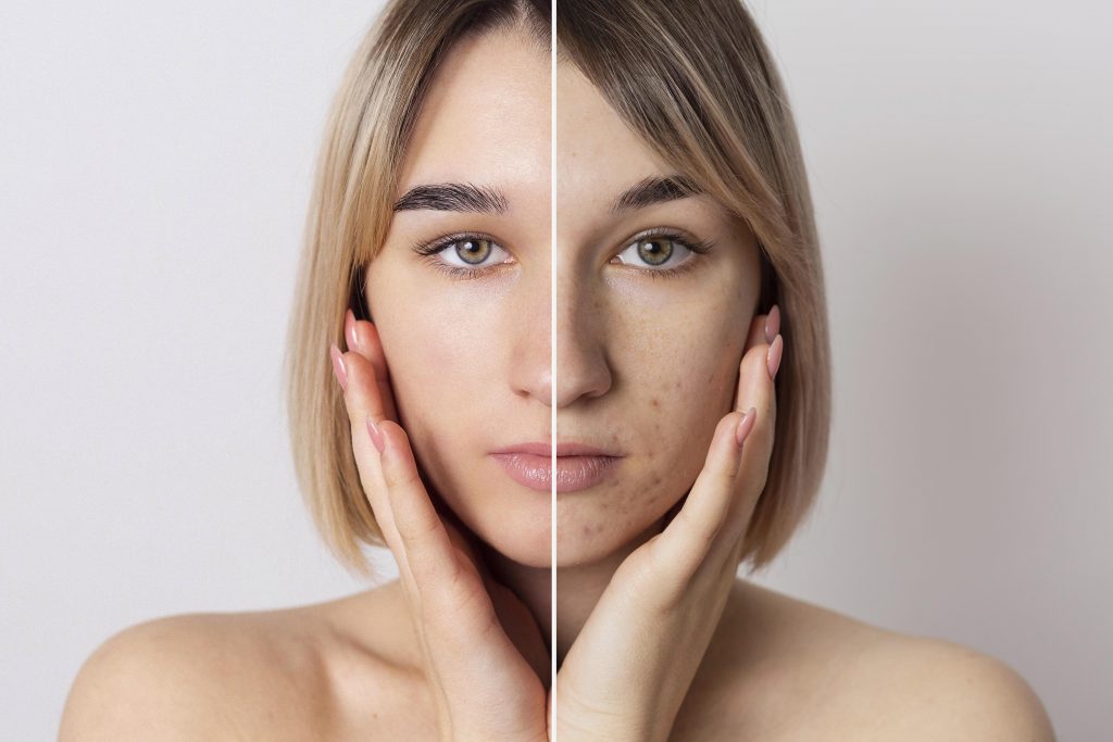 Imagen de mujer con el rostro dividido en antes y después para contrastar los resultados del tratamiento de peeling facial donde podemos contemplar los resultados óptimos