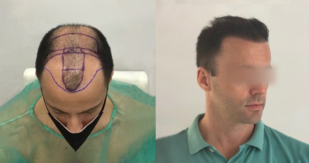 Hombre joven Antes y Después trasplante de pelo en nuestra clínica de injerto capilar pixelado