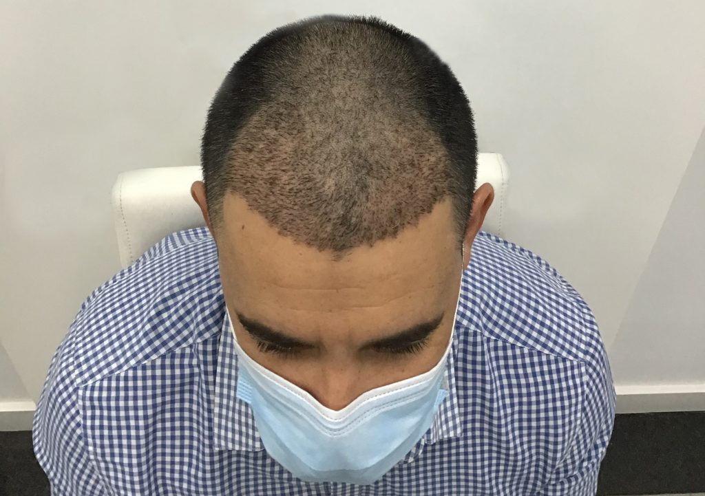 Hombre con un resultado extraordinario después de injerto capilar en clínica especialista en injerto capilar